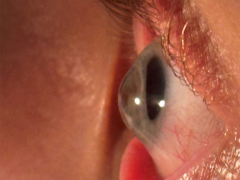 The potential of scleral lenses